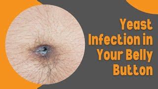 can a belly button infection kill you|Caring for Your Belly Button: How to Prevent Problems